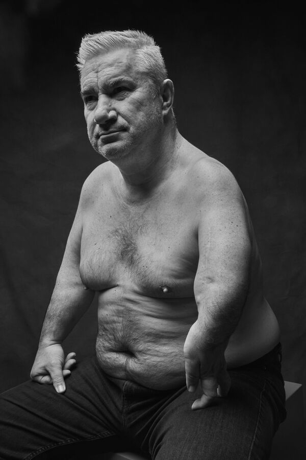 No tengo más que perder: víctimas del fármaco talidomida en España luchan por su resarcimiento - Sputnik Mundo