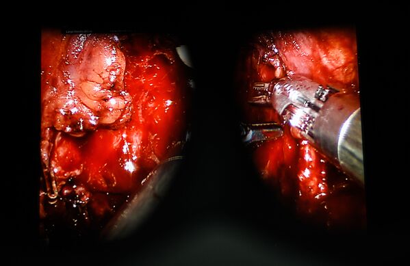 Medicina moderna: así opera el robot cirujano Da Vinci 

 - Sputnik Mundo