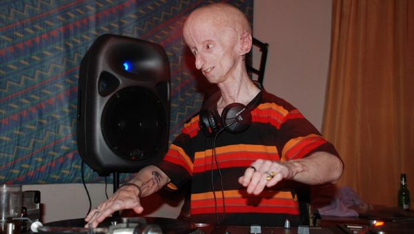 Una persona con progeria Una persona con progeria - Sputnik Mundo