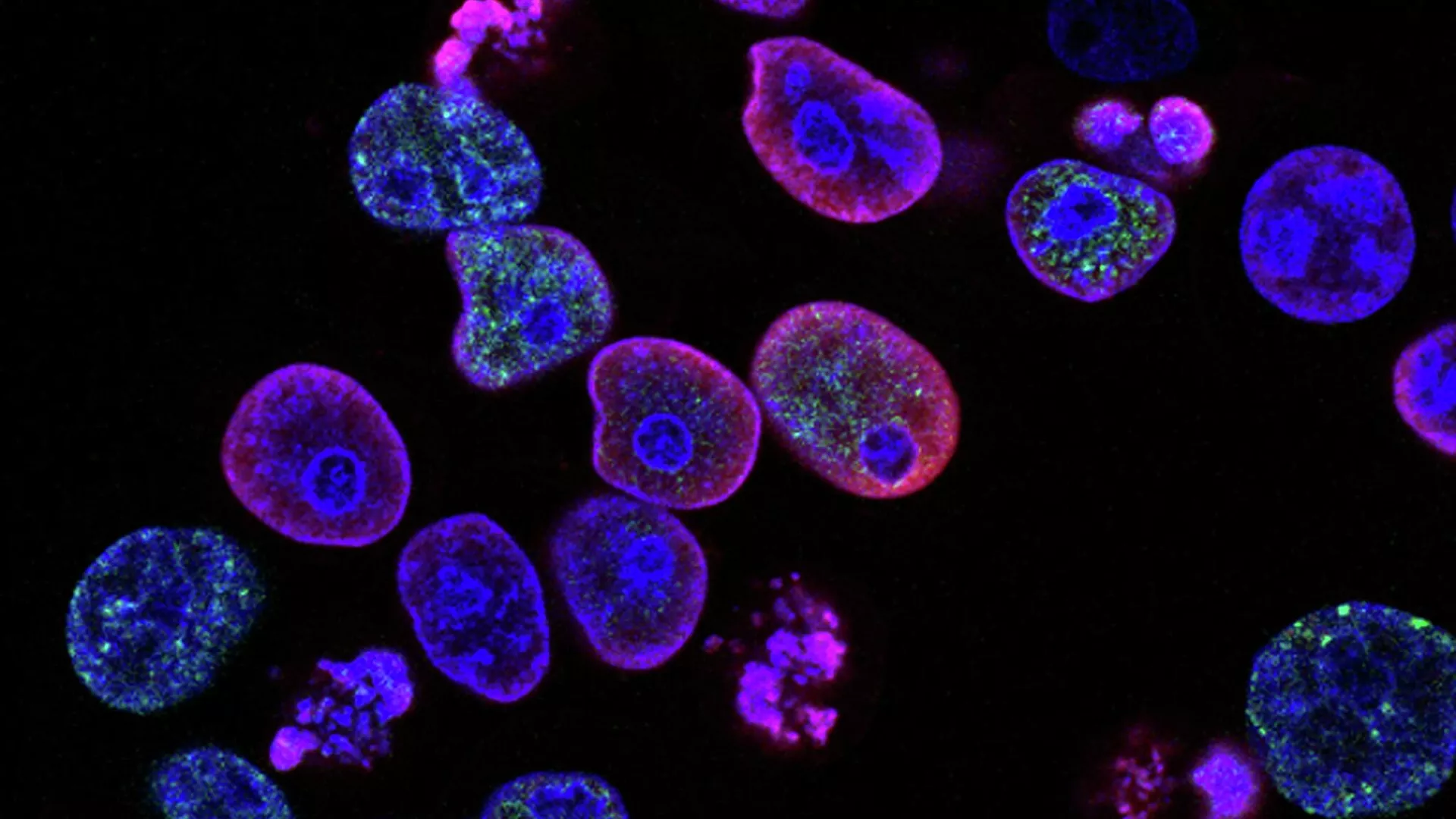 Células de cáncer (imagen referencial)
