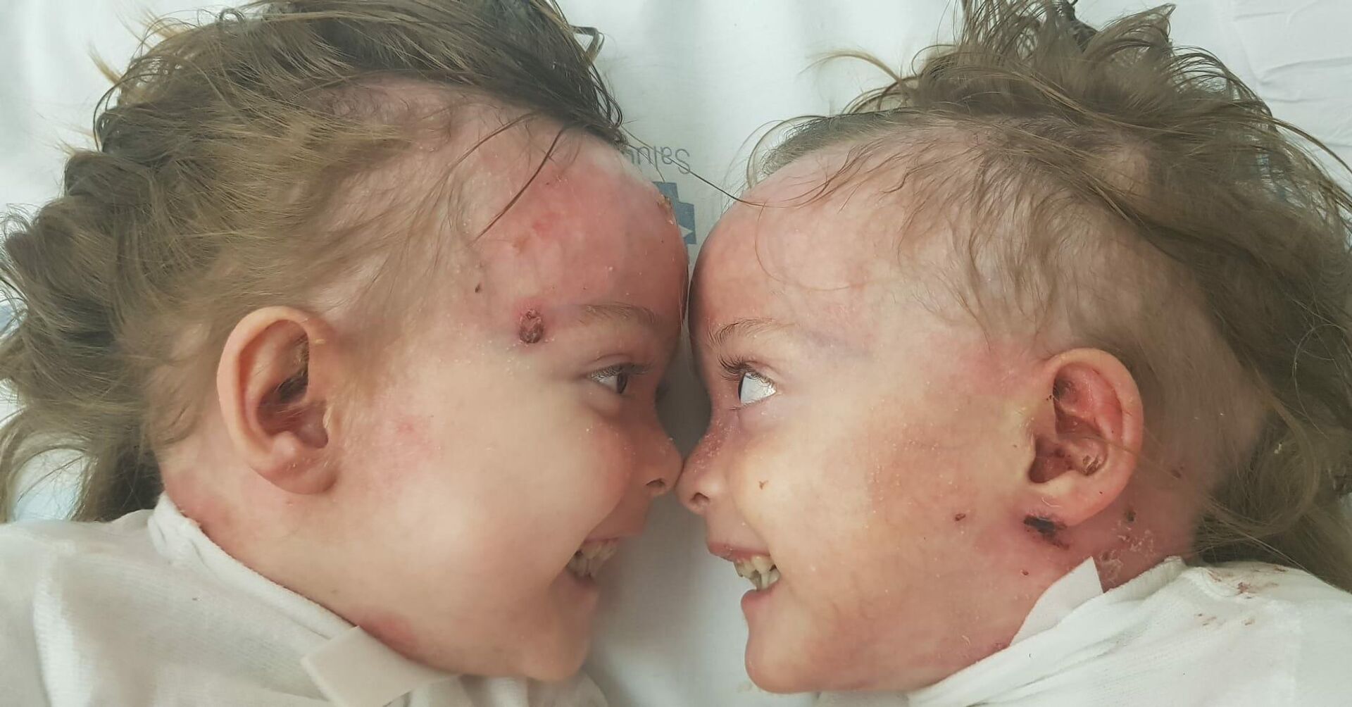 Noa y Carla, afectadas por la piel de mariposa - Sputnik Mundo, 1920, 26.04.2021