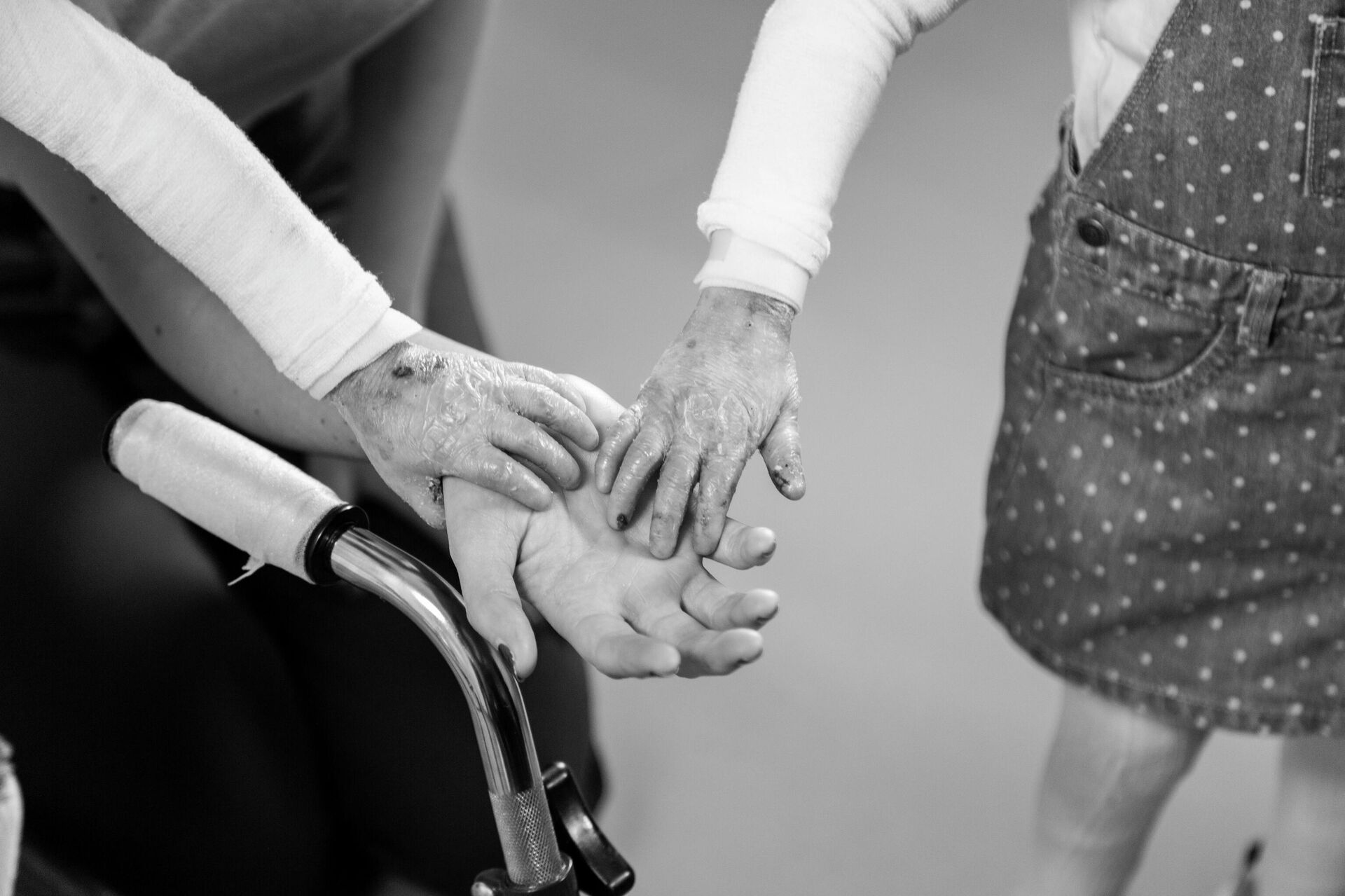 Las manos heridas de Noa y Carla - Sputnik Mundo, 1920, 26.04.2021