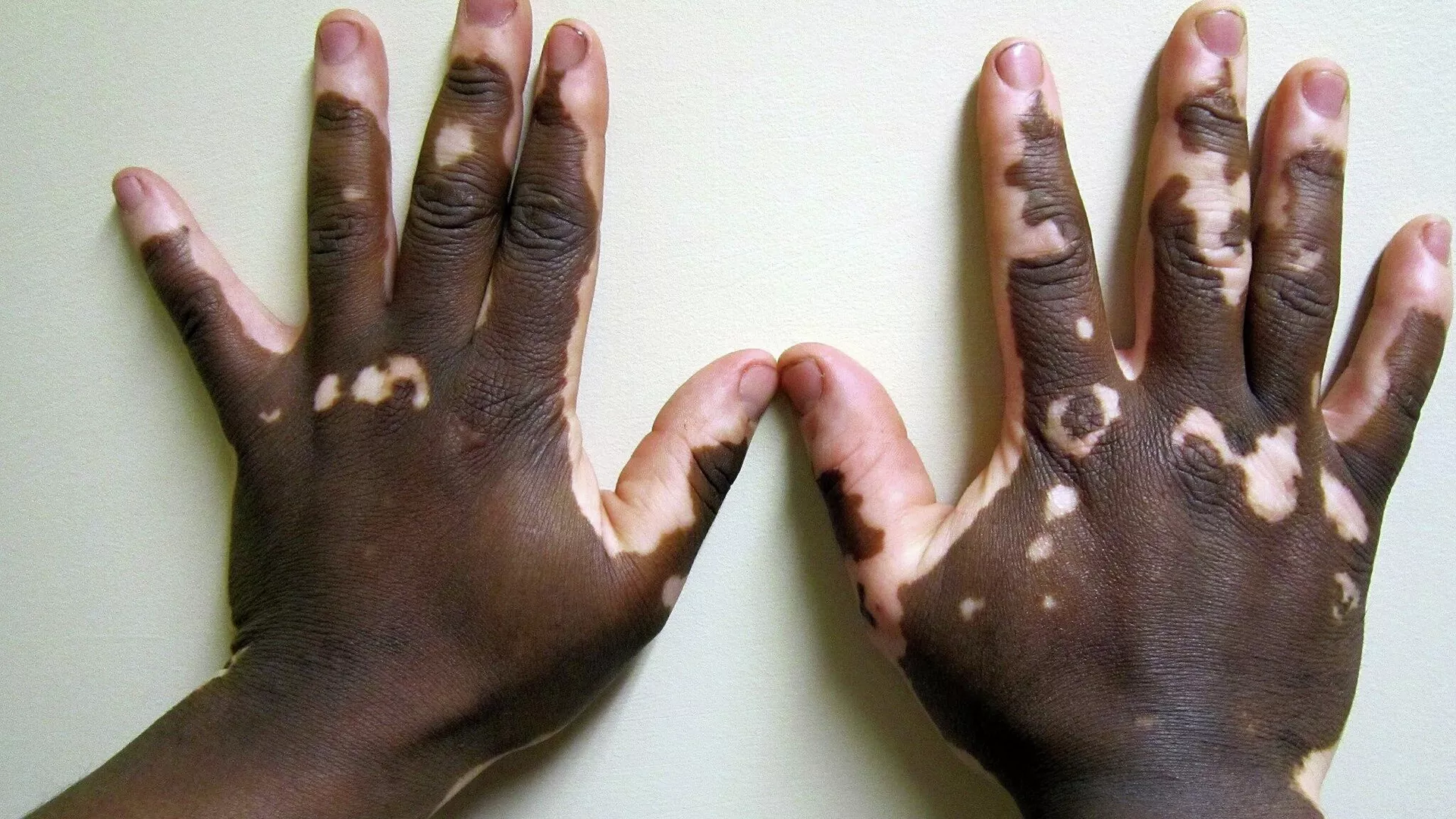 Vitiligo
