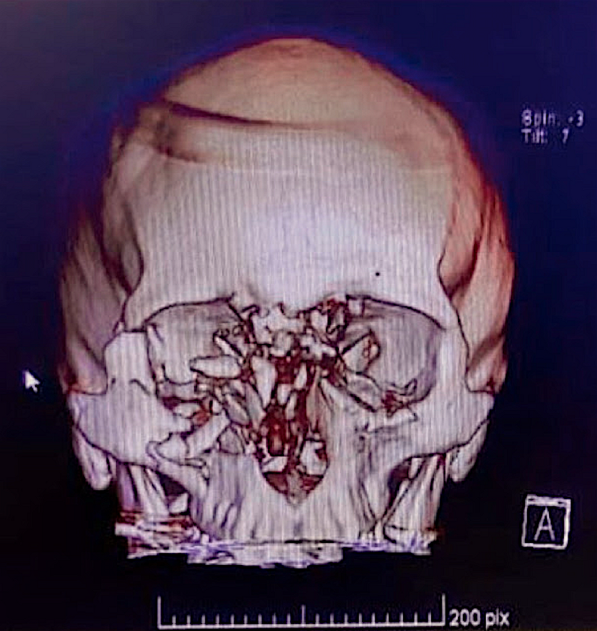 Tomografía del rostro de Fabiola Campillai en la cual se aprecian los daños causados - Sputnik Mundo, 1920, 14.06.2021