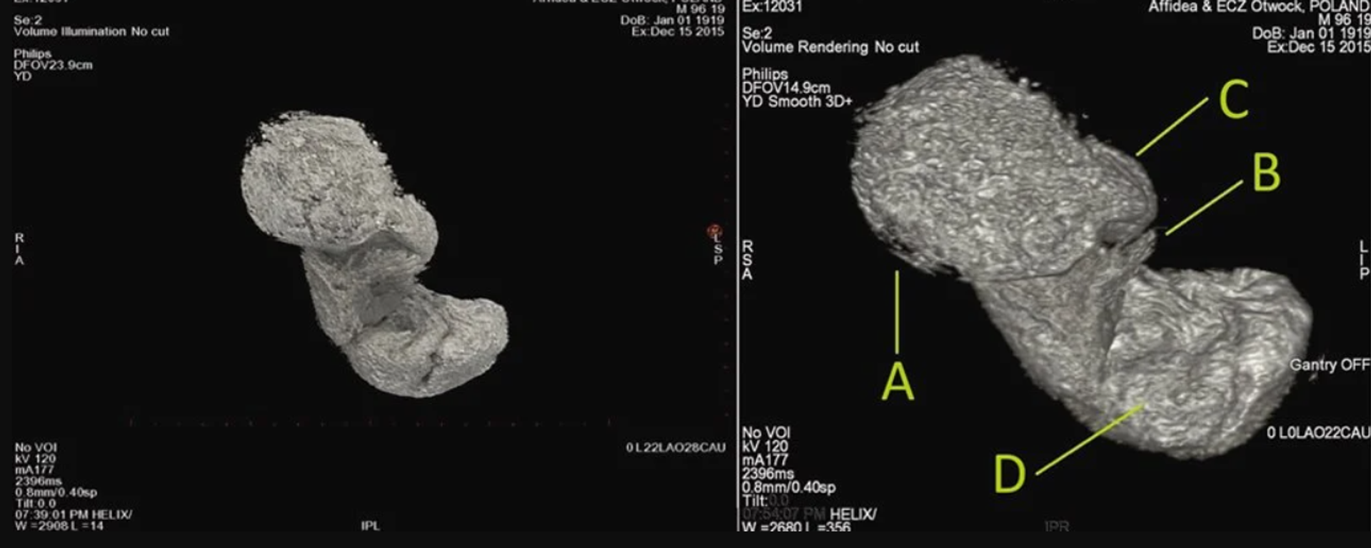 Imagen del feto momificado - Sputnik Mundo, 1920, 26.01.2022