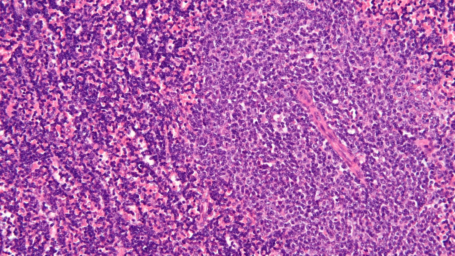 Micrografía de un nodo linfático afectado por leucemia linfocítica crónica Micrografía de un nodo linfático afectado por leucemia linfocítica crónica - Sputnik Mundo, 1920, 11.02.2022