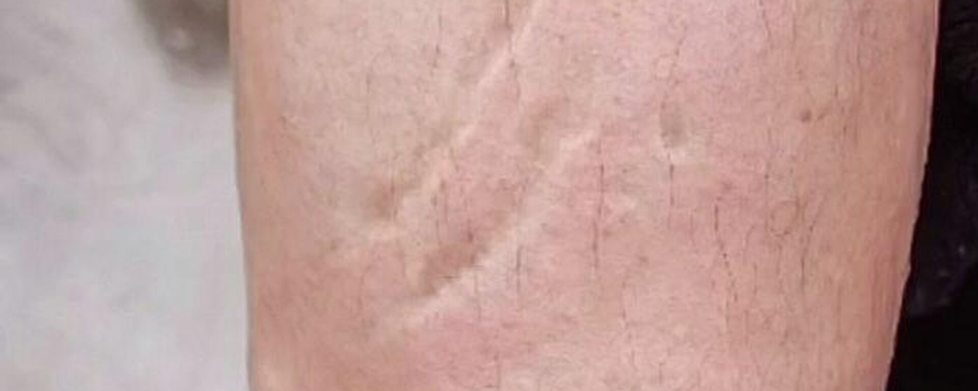 Quemadura con ácido - Sputnik Mundo, 1920, 27.05.2022