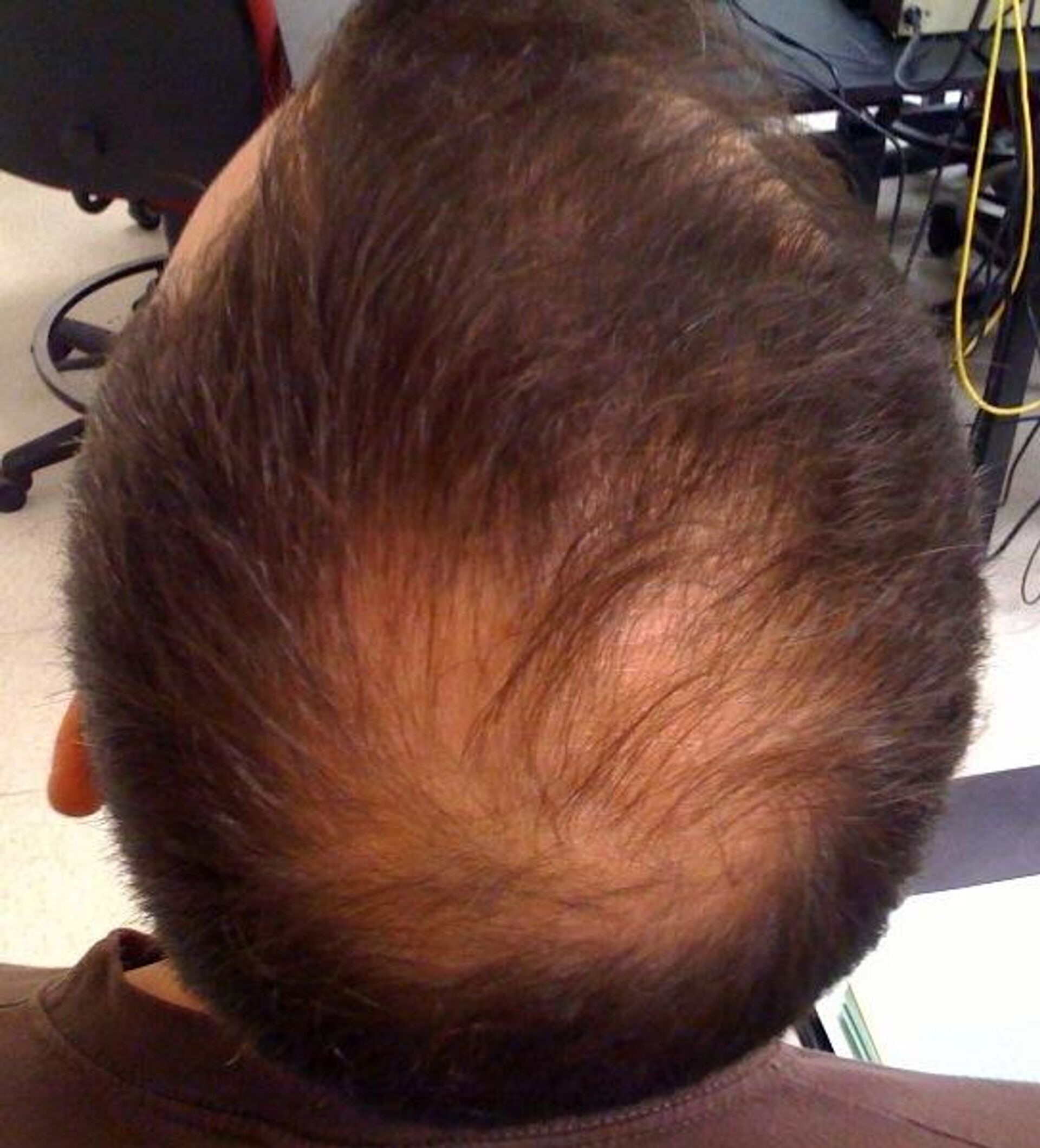 Alopecia androgénica - Sputnik Mundo, 1920, 21.10.2022