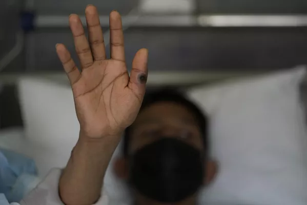 Un paciente muestra la llaga que produjo en su mano la viruela del mono en el Hospital Arzobispo Loayza de Lima, Perú, el 16 de agosto. Un paciente muestra la llaga que produjo en su mano la viruela del mono en el Hospital Arzobispo Loayza de Lima, Perú, el 16 de agosto. - Sputnik Mundo