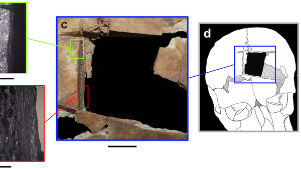 Trepanación de uno de los hermanos de la élite del Bronce Tardío de Megiddo, Israel - Sputnik Mundo