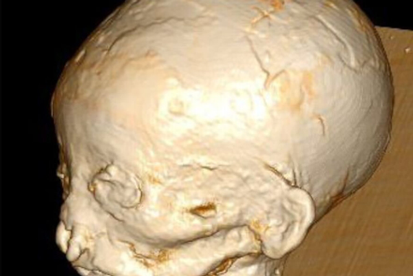 Reconstrucción de tomografía computarizada de representación de volumen de la cabeza que demuestra una boca abierta con labios superior e inferior conservados, incisivos superiores visibles y la sospecha de una lengua protuberante. Los pómulos prominentes son visibles. En general, el niño tiene un aspecto de “facies de roedor”. Las fosas nasales están llenas de rollos de tela y los ojos están cubiertos por tela. La aurícula izquierda está bien conservada y reveló una pequeña muesca en el lóbulo anterior de la oreja. - Sputnik Mundo