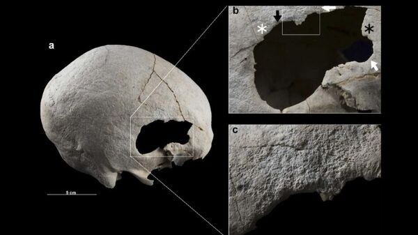 Cráneo de mujer con dos trepanaciones. - Sputnik Mundo