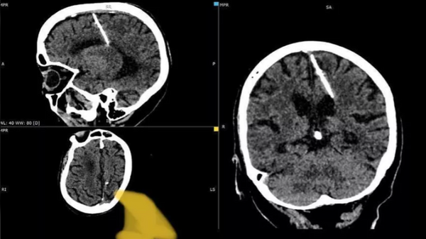 Mujer de 80 años vive con una aguja en el cerebro  - Sputnik Mundo