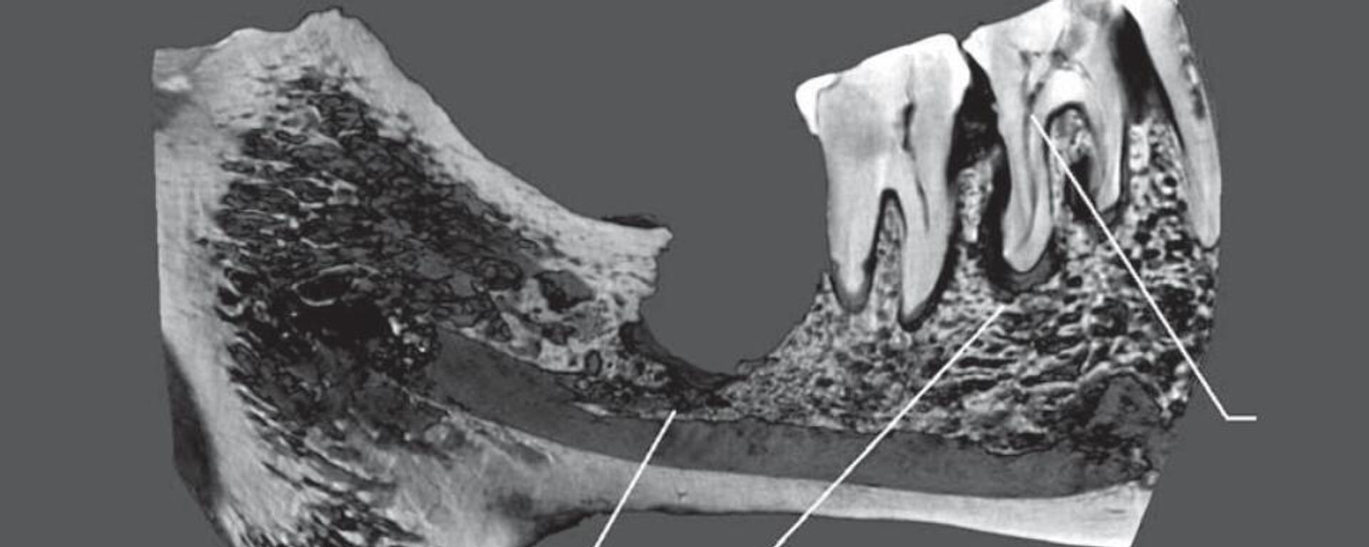 Tomografía de la mandíbula de una mujer del cementerio Oleneostróvsky con indicios de intervenciones quirúrgicas - Sputnik Mundo, 1920, 05.01.2024