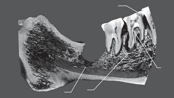 Tomografía de la mandíbula de una mujer del cementerio Oleneostróvsky con indicios de intervenciones quirúrgicas - Sputnik Mundo