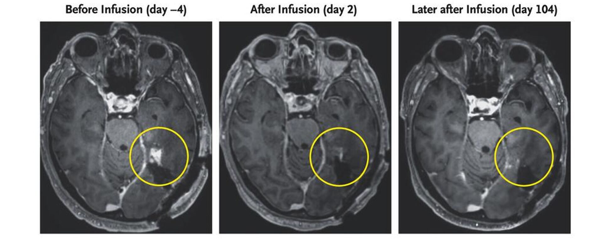 Resonancia magnética de un paciente de 72 años con un glioblastoma - Sputnik Mundo, 1920, 15.03.2024