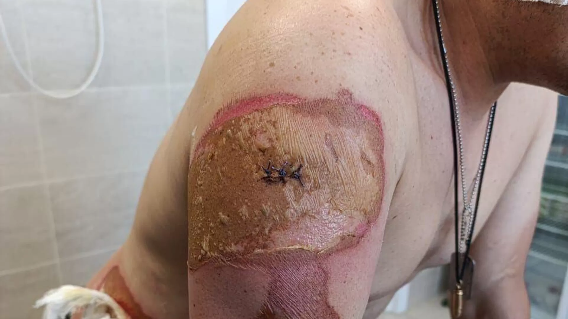 Secuelas del ataque de un dron ucraniano contra el asesor del jefe de la república popular de Donetsk, Yan Gaguin