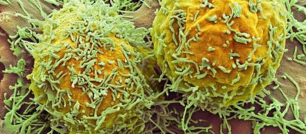 Cáncer - Sputnik Mundo