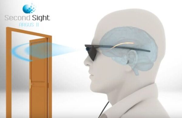 Implante de visión artificial Argus II - Sputnik Mundo