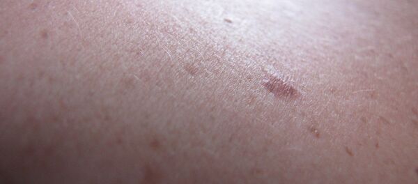 Piel de una persona - Sputnik Mundo