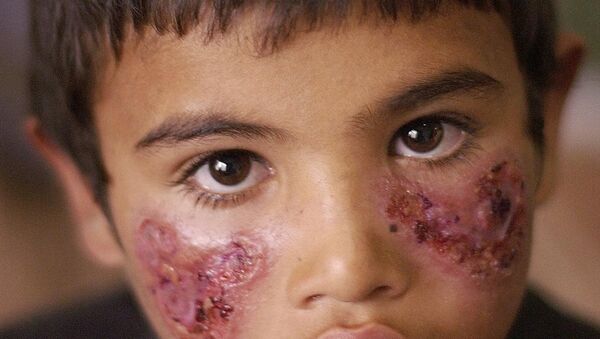 Un niño enfermo de leishmaniasis - Sputnik Mundo