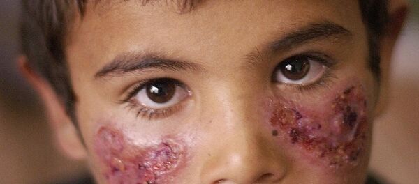 Un niño enfermo de leishmaniasis - Sputnik Mundo