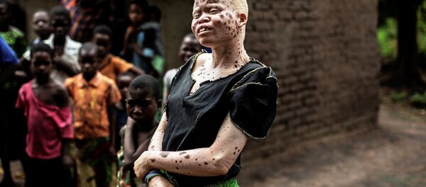 Mainasi Issa, una albina de Malaui - Sputnik Mundo