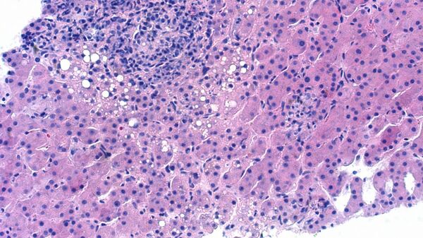 Mycobacterium avium-complex granulomatous hepatitis - Sputnik Mundo