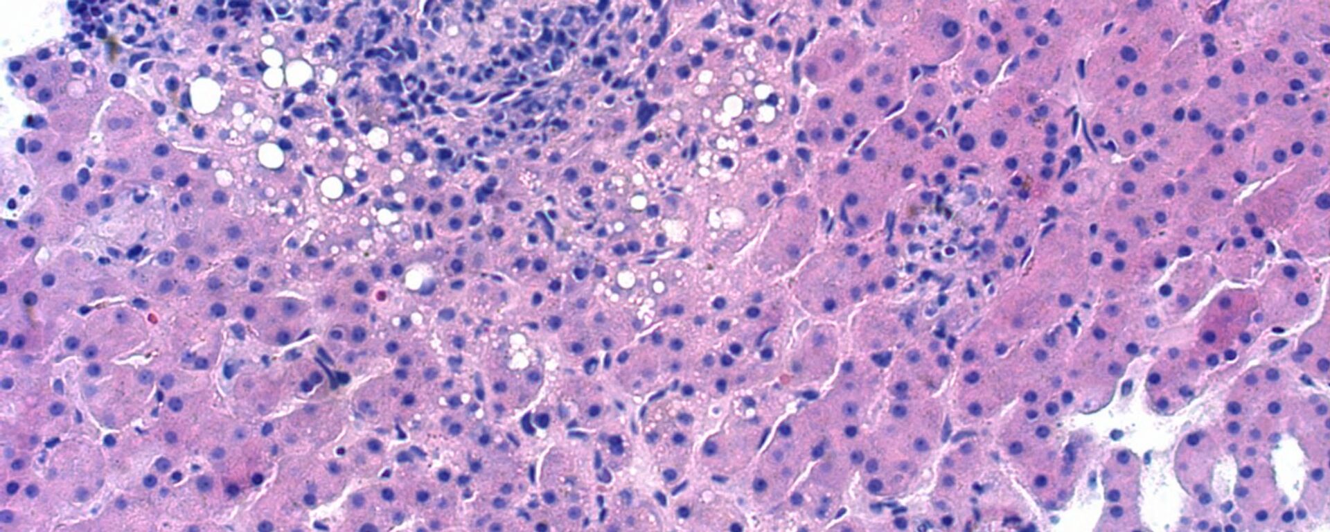 Mycobacterium avium-complex granulomatous hepatitis - Sputnik Mundo, 1920, 05.05.2022