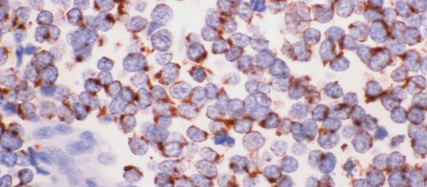 Las células cancerosas - Sputnik Mundo