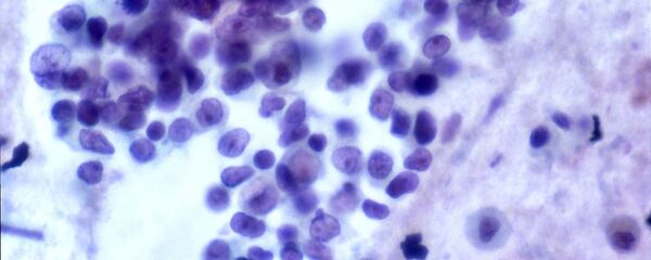 Células de cáncer Células de cáncer - Sputnik Mundo