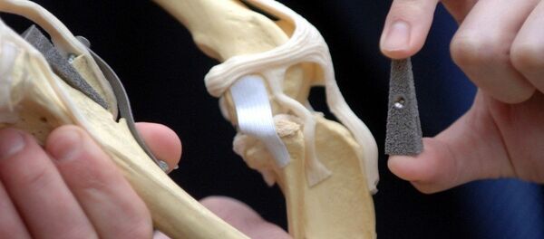 Implante de hueso - Sputnik Mundo