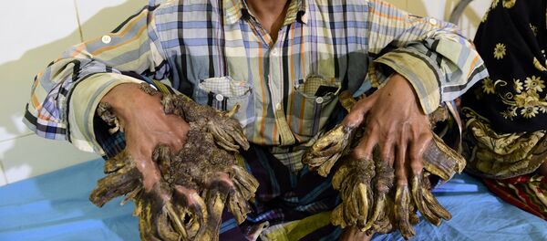 Abul Bajandar, el 'hombre árbol' de Bangladesh - Sputnik Mundo