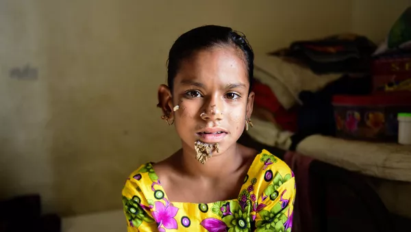 In this photograph taken on January 30, 2017, Bangladeshi patient Sahana Khatun, 10, poses for a photograph at the Dhaka Medical College and Hospital. - Sputnik Mundo