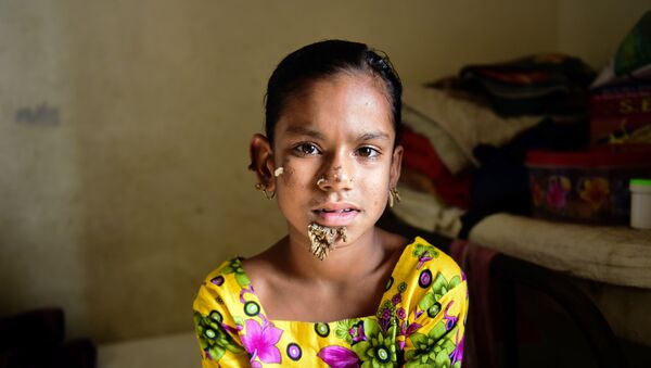 Sahana Khatun, la primera 'niña árbol' - Sputnik Mundo