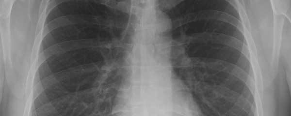 Radiografía de pulmón - Sputnik Mundo