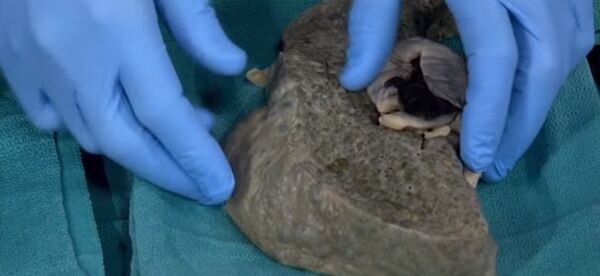 Imágen de hígado dañado por alcohol Imágen de hígado dañado por alcohol - Sputnik Mundo