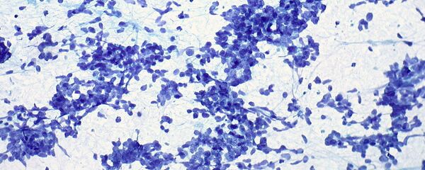 Células de cáncer (imagen referencial) - Sputnik Mundo