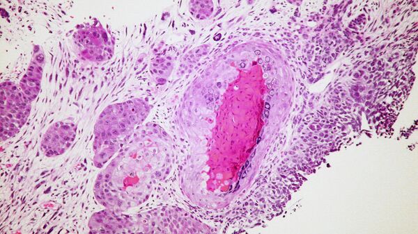 Células de cáncer (imagen referencial) - Sputnik Mundo