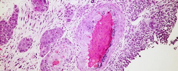 Células de cáncer (imagen referencial) - Sputnik Mundo