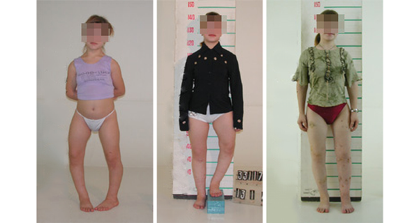 Paciente de 14 años con deformaciones congénitas de las extremidades inferiores, estatura de 135 cm. Se realizó una corrección de las piernas con alargamiento de siete centímetros. La estatura tras el tratamiento es de 143 cm. - Sputnik Mundo