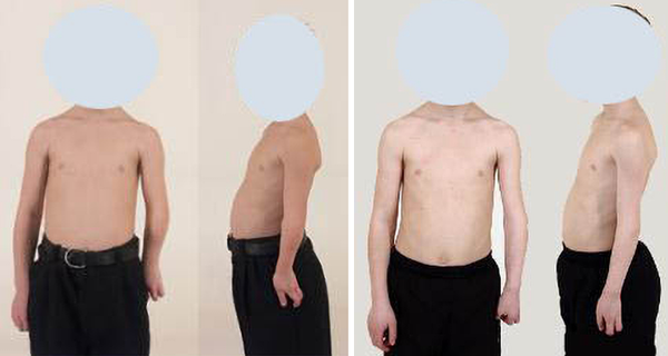 Paciente de 16 años con displasia postraumática de codo. Alargamiento de ocho centímetros. - Sputnik Mundo