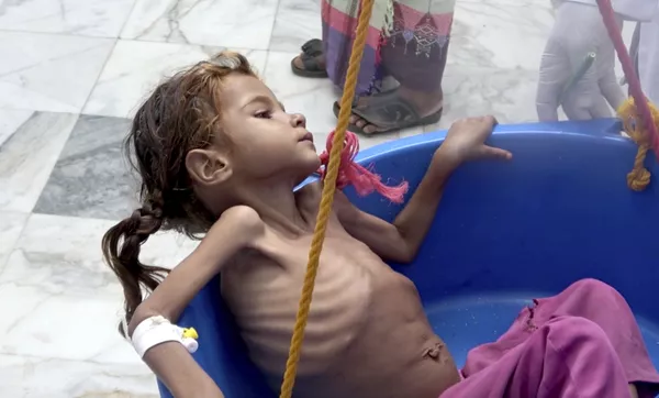 Niña yemení sufre de malnutrición, consecuencia de la guerra y el bloqueo de Arabia Saudí, 25 de agosto de 2018, Hajjah (Yemen) Niña yemení sufre de malnutrición, consecuencia de la guerra y el bloqueo de Arabia Saudí, 25 de agosto de 2018, Hajjah (Yemen) - Sputnik Mundo