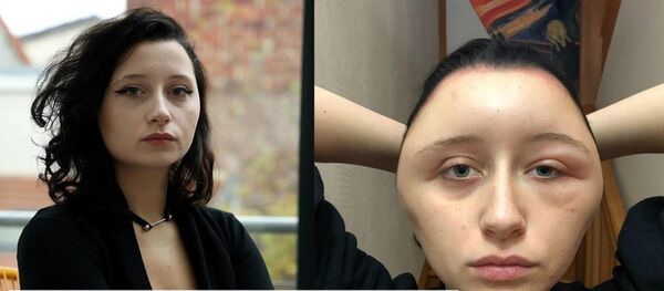 A una joven se le desfigura el rostro después de teñirse el pelo A una joven se le desfigura el rostro después de teñirse el pelo - Sputnik Mundo