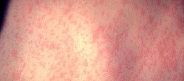 Sarampión - Sputnik Mundo