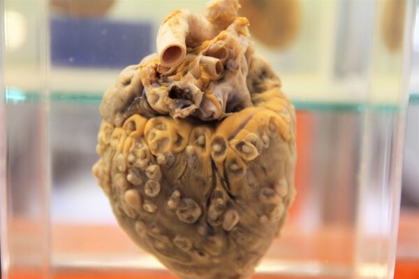 Pieza del Museo de patologías veterinarias de la UNAM. Corazón con cisticercosis. - Sputnik Mundo