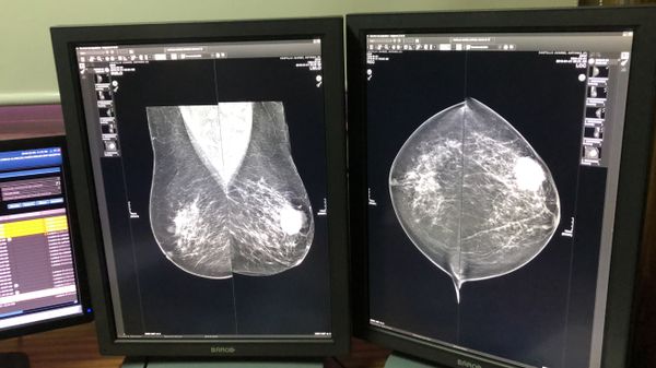 El proceso de la detección de biomarcadores tumorales de cáncer de mama - Sputnik Mundo