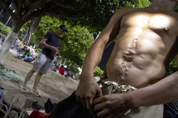 Ex-militar salvadoreño muestra las operaciones en su abdomen, tras un atentado con armas de fuego en su país, Huehuetán, Chiapas, México - Sputnik Mundo