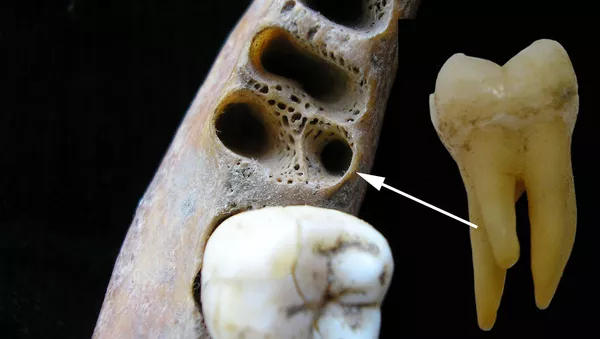 Molar inferior de tres raíces 