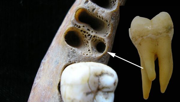 Molar inferior de tres raíces  - Sputnik Mundo